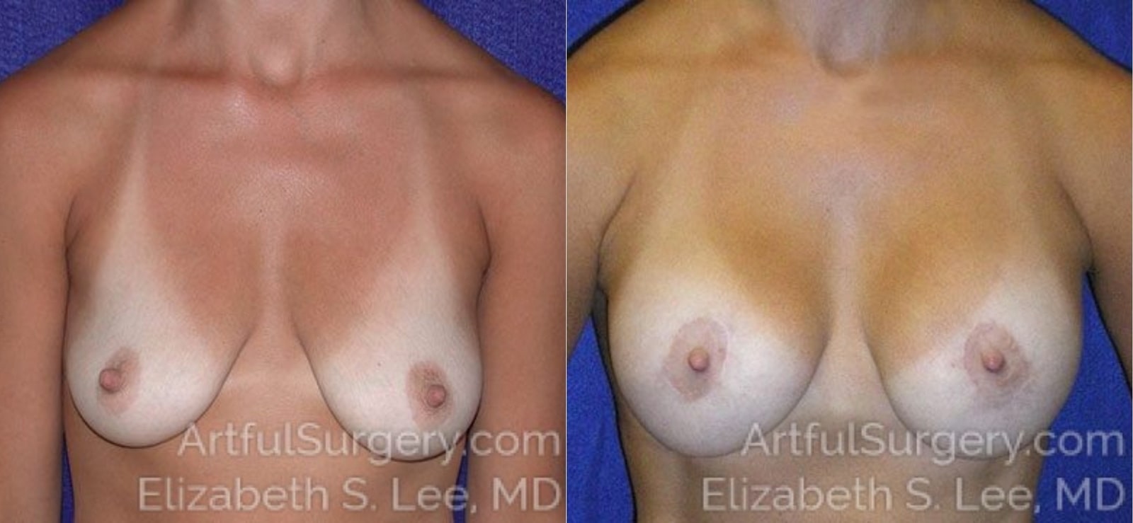 Picture of Breast Augmentation-1