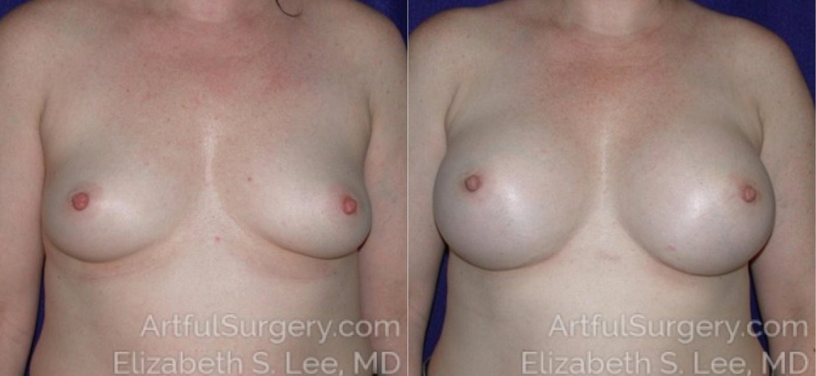 Picture of Breast Augmentation-11