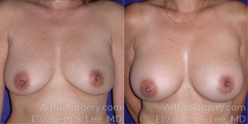 Picture of Breast Augmentation-12