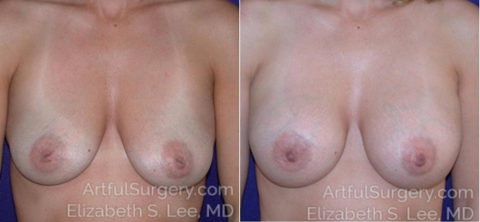 Picture of Breast Augmentation-14