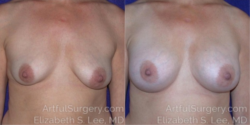 Picture of Breast Augmentation-16