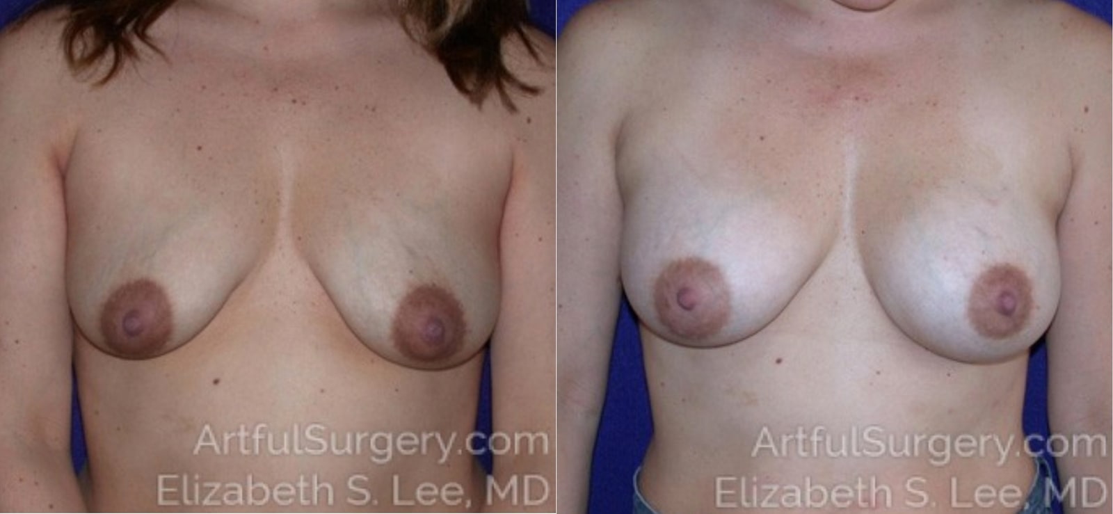 Picture of Breast Augmentation-19