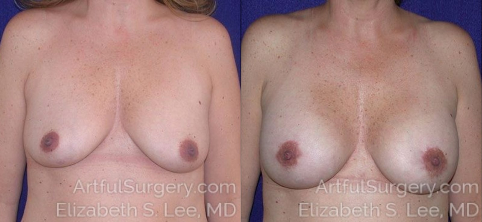 Picture of Breast Augmentation-3
