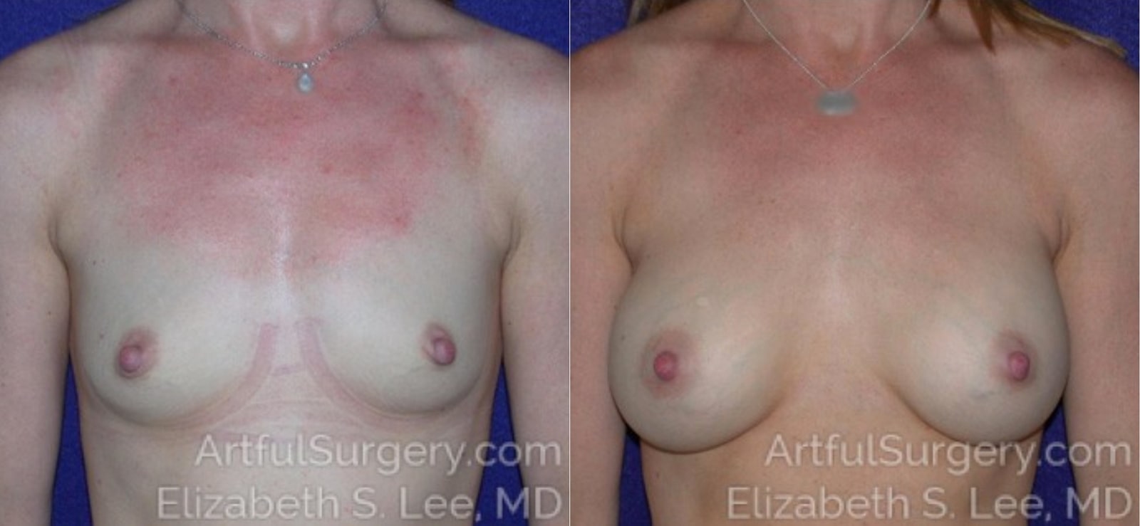 Picture of Breast Augmentation-20