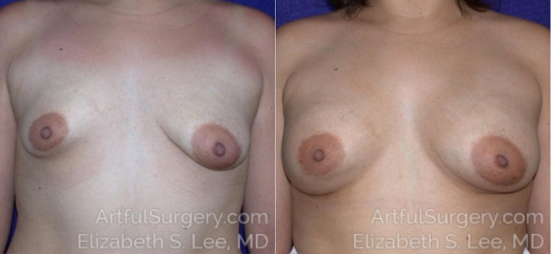 Picture of Breast Augmentation-22