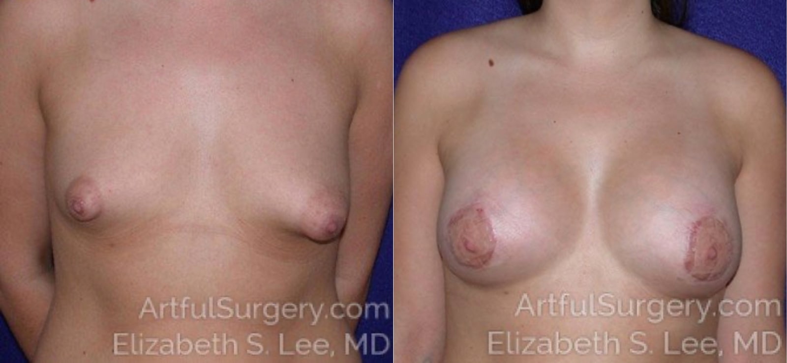 Picture of Breast Augmentation-3