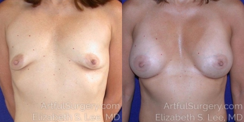 Picture of Breast Augmentation-8