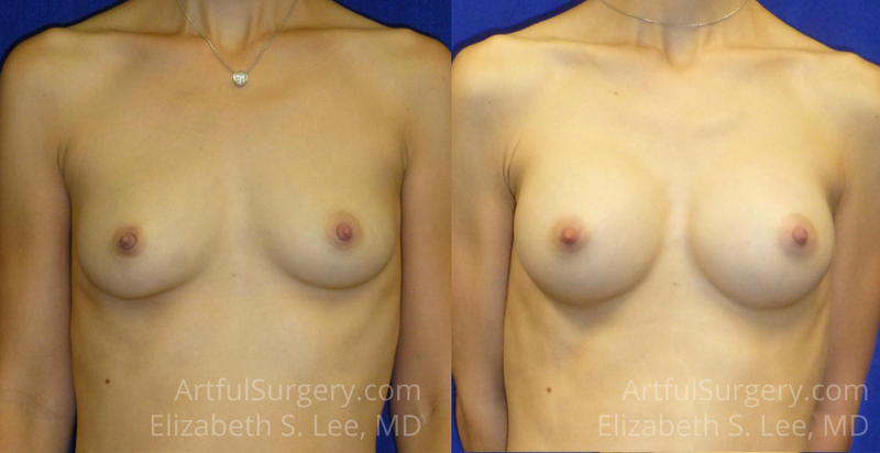 Picture of Breast Augmentation-9