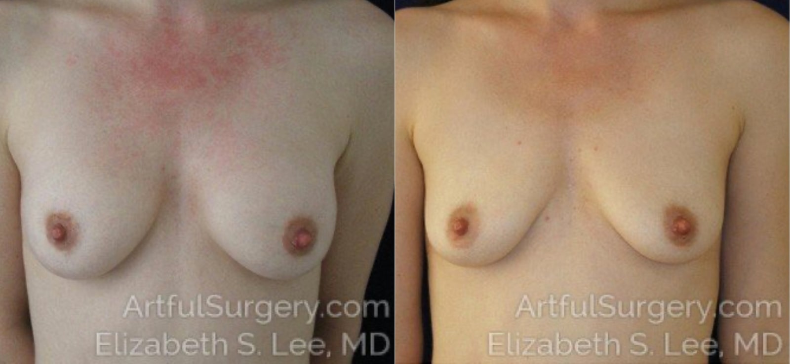 Picture of Breast Implant Removal-1