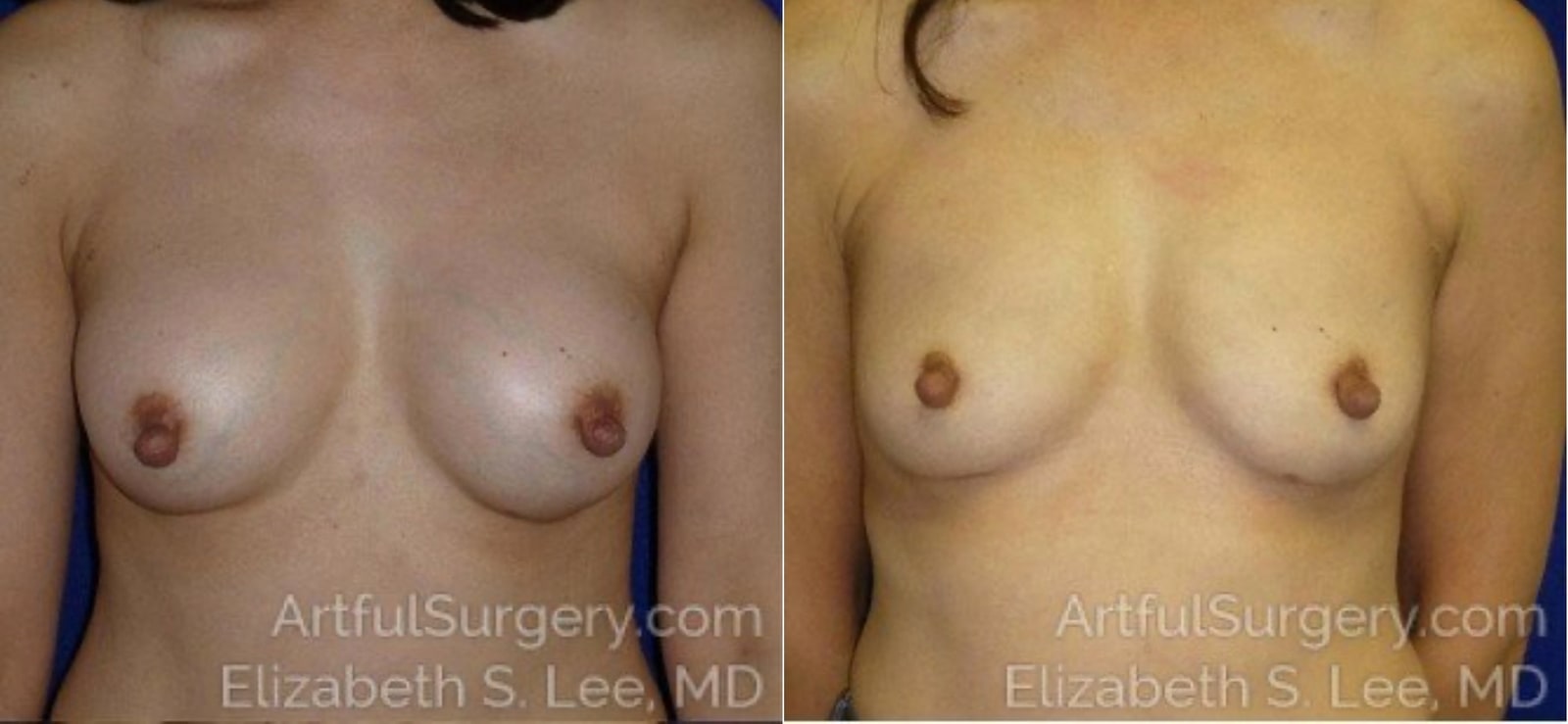Picture of Breast Implant Removal-10