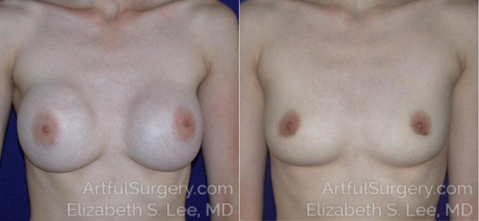 Picture of Breast Implant Removal-2