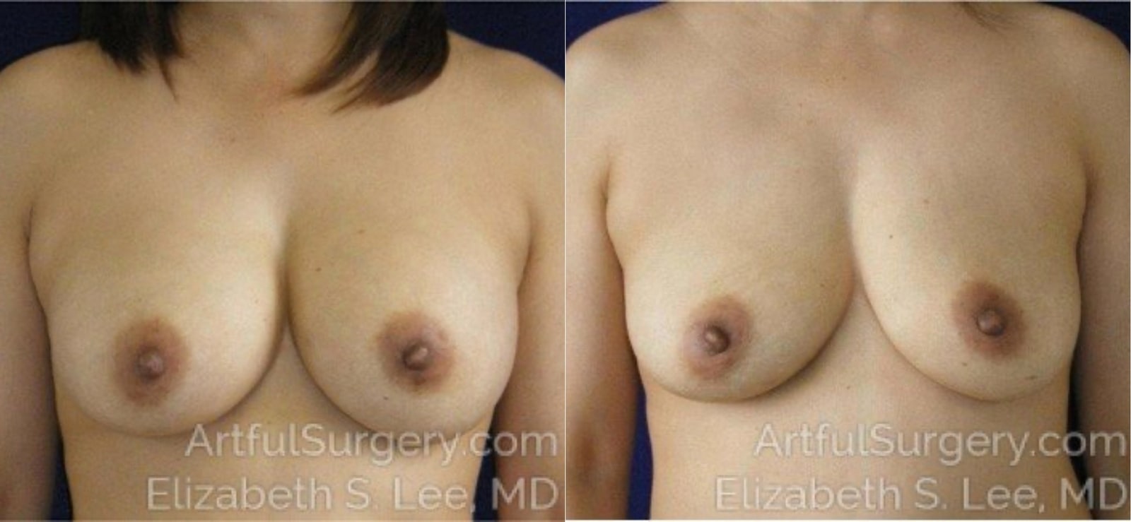 Picture of Breast Implant Removal-7