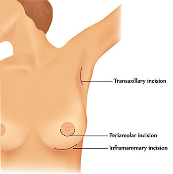 Picture of Breast augmentation Techniques