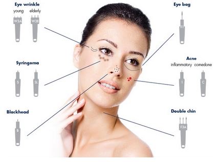 Agnes RF: Precision Skin Treatment for Facial Contouring, Eye Bags and Acne