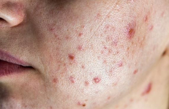 Clearer Skin is Possible: Treating Acne at ArtfulSurgery