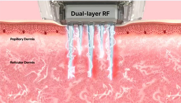 AGNES RF for Face and Body at ArtfulSurgery: Precision Contouring and Skin Tightening—Now Enhanced with 3DTite
