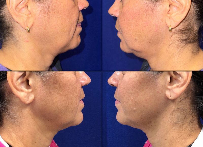 Picture of CoolSculpting-01