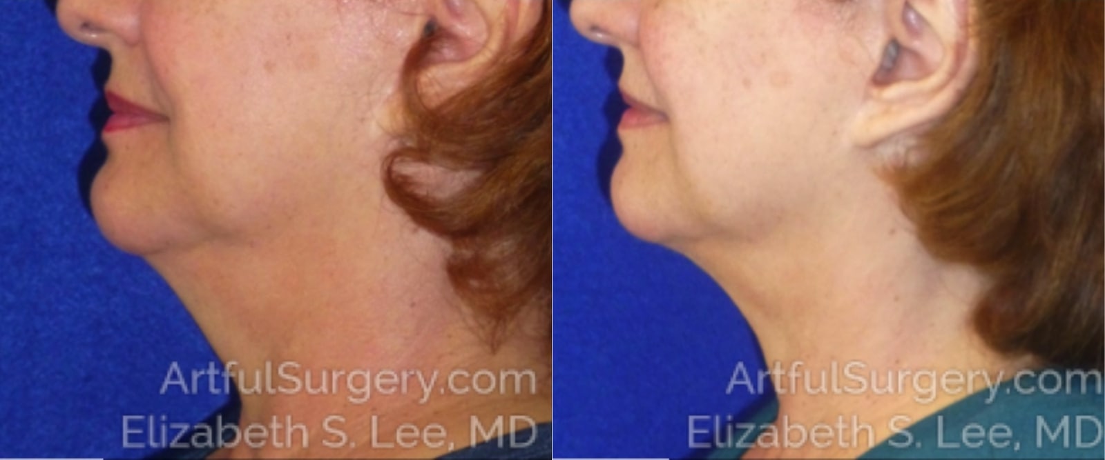 Picture of CoolSculpting-10a