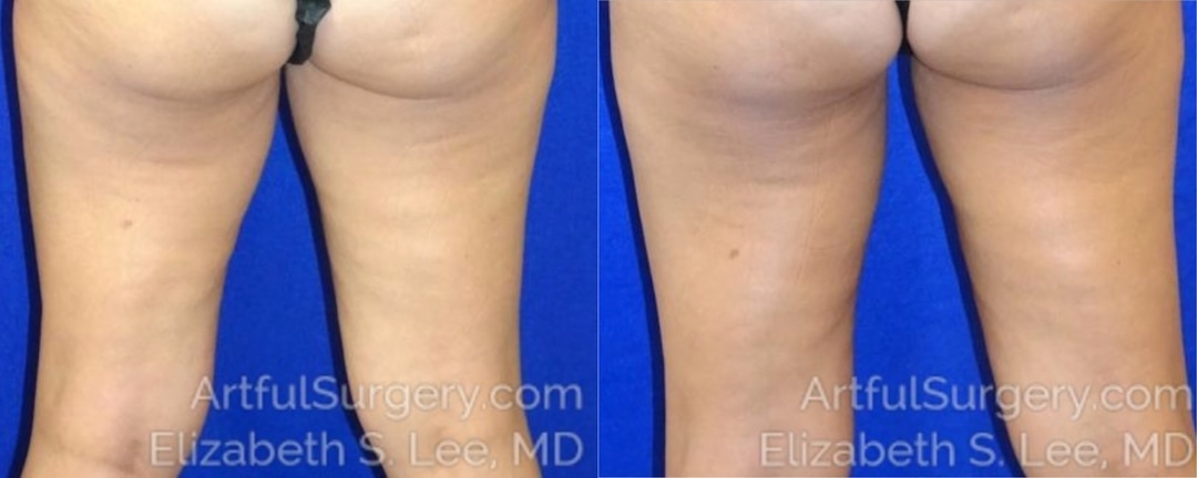 Picture of CoolSculpting-11a