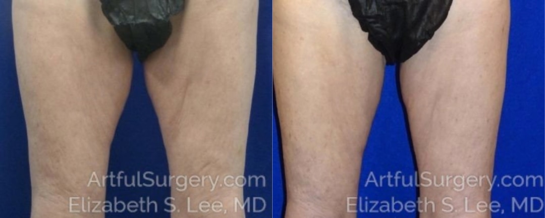 Picture of CoolSculpting-12