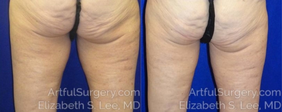 Picture of CoolSculpting-12a