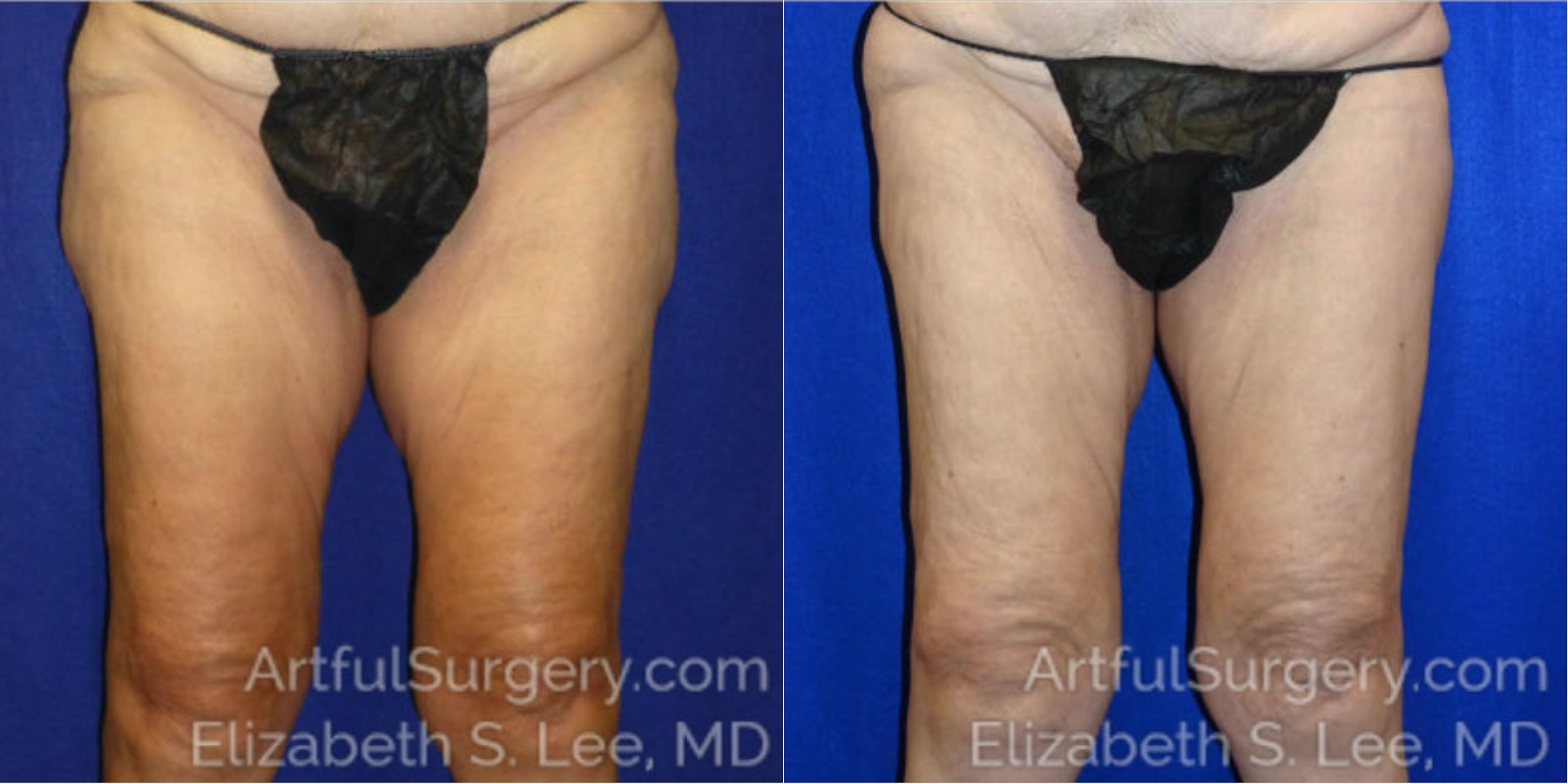 Picture of CoolSculpting-13
