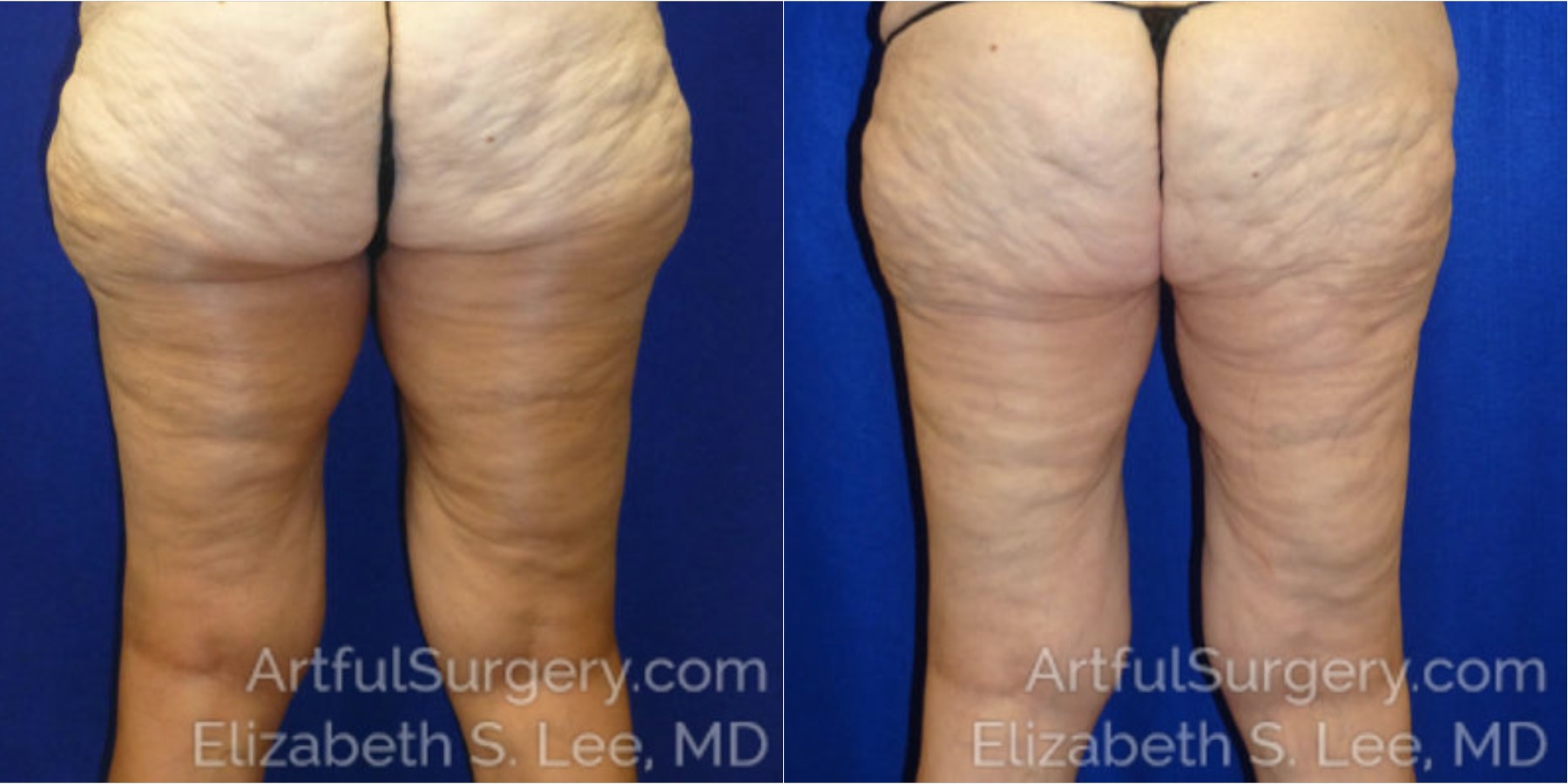 Picture of CoolSculpting-13a