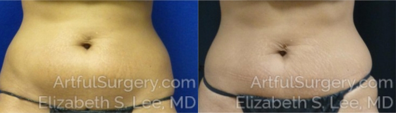 Picture of CoolSculpting-15