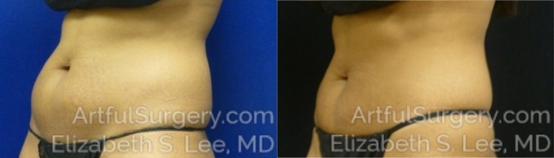 Picture of CoolSculpting-15A