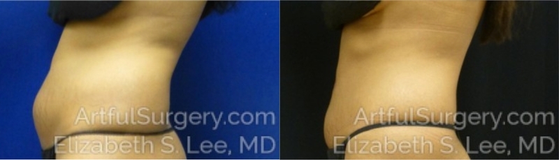 Picture of CoolSculpting-15B