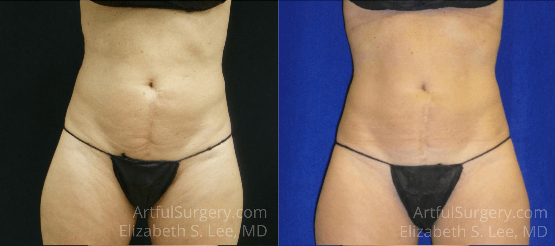 Picture of CoolSculpting-16