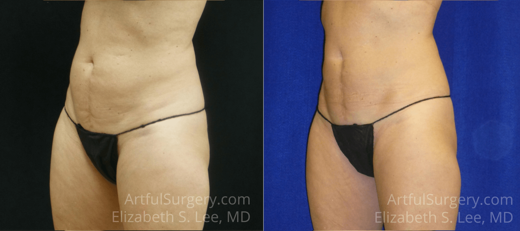 Picture of CoolSculpting-16B