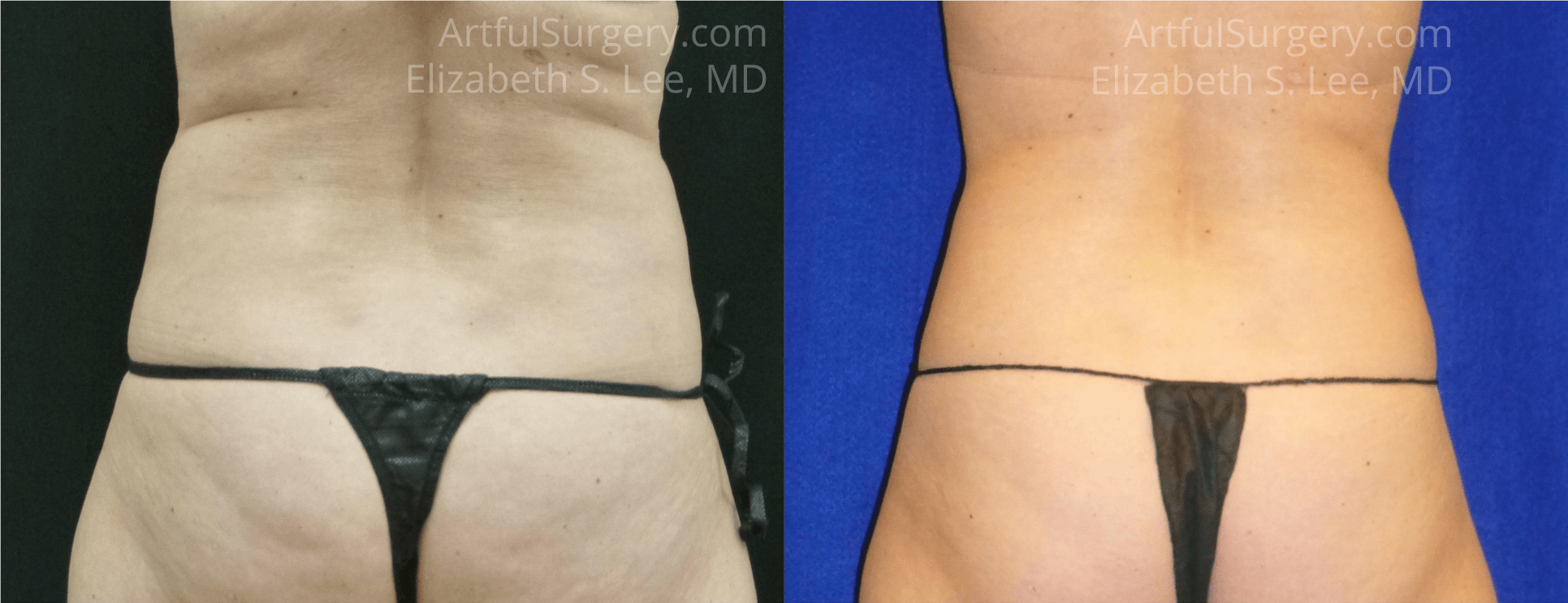 Picture of CoolSculpting-17