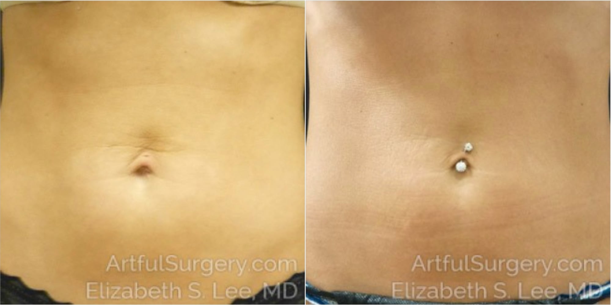 Picture of CoolSculpting-18