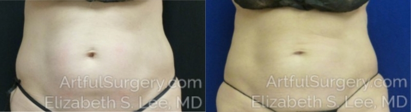 Picture of CoolSculpting-19