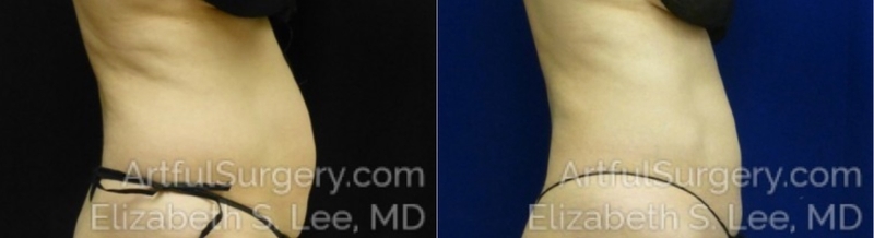 Picture of CoolSculpting-19a