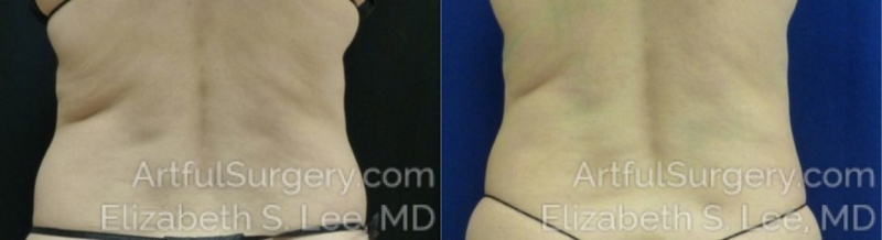 Picture of CoolSculpting-19b