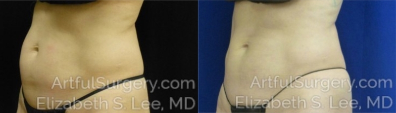 Picture of CoolSculpting-19c