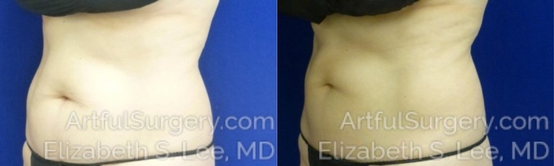 Picture of CoolSculpting-02