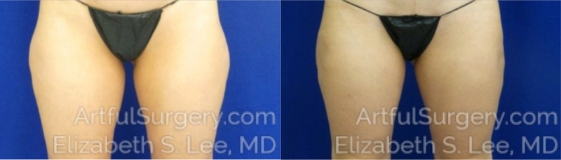 Picture of CoolSculpting-20