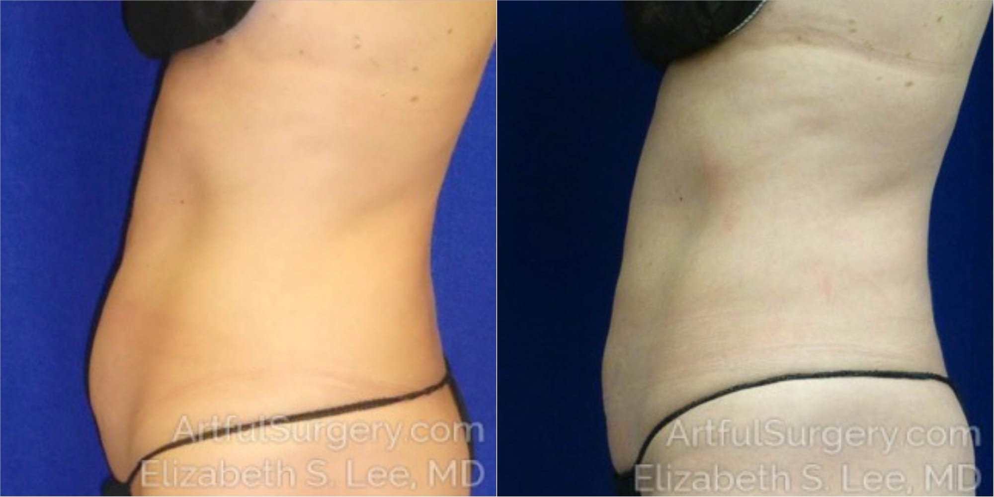 Picture of CoolSculpting-21