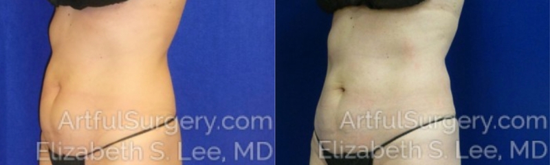 Picture of CoolSculpting-21a