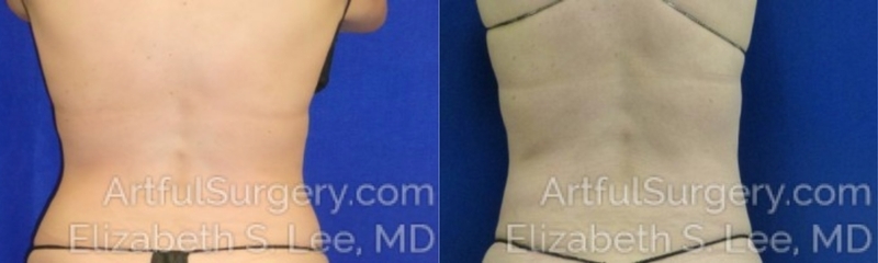 Picture of CoolSculpting-21b