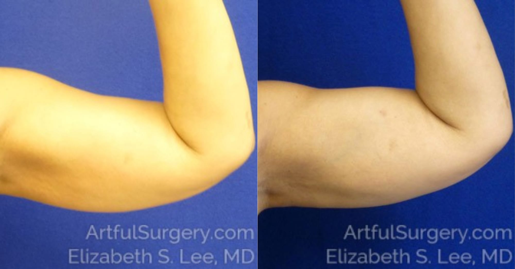 Picture of CoolSculpting-22