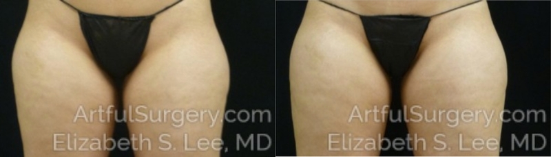 Picture of CoolSculpting-23