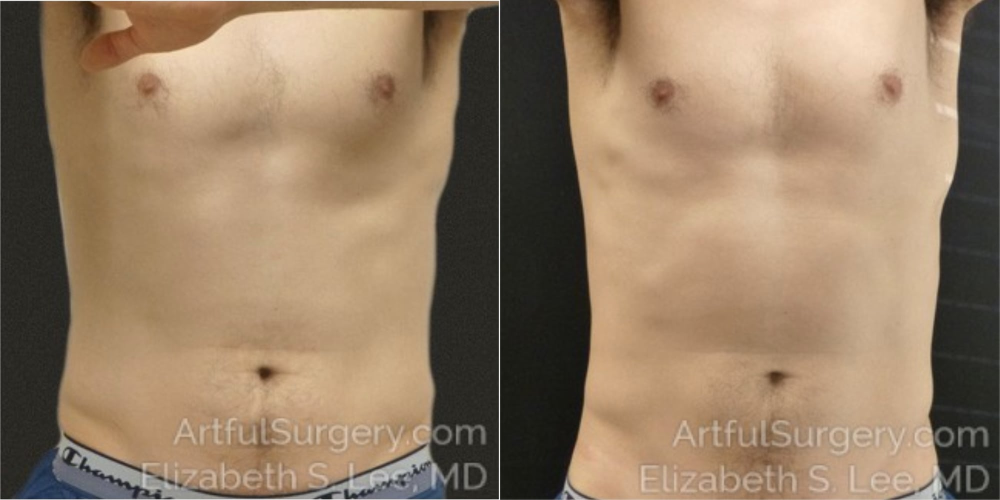 Picture of CoolSculpting-24