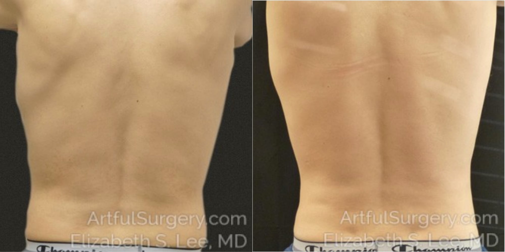 Picture of CoolSculpting-24a