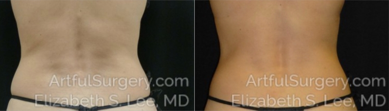 Picture of CoolSculpting-25