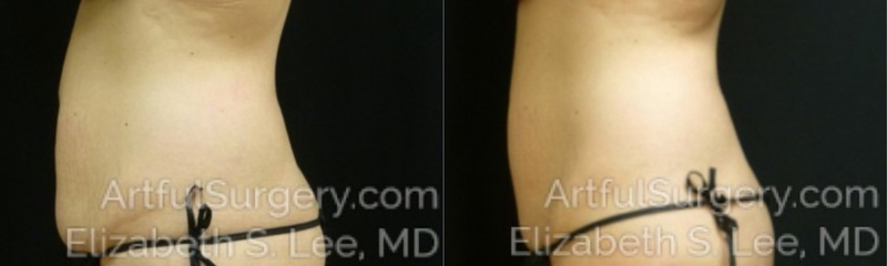 Picture of CoolSculpting-26
