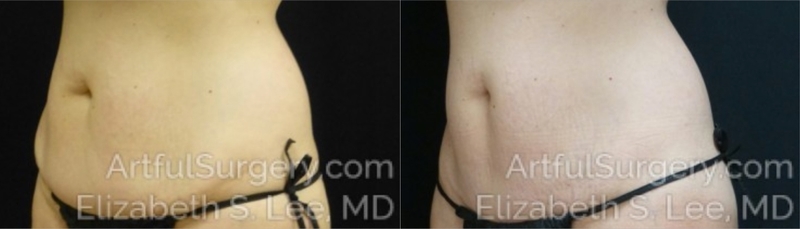 Picture of CoolSculpting-26a